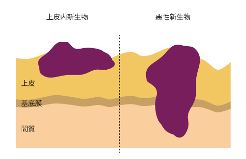 悪性新生物と上皮内新生物の違い 四日市で保険相談 保険見直し 保険の悩みなら アニマート株式会社